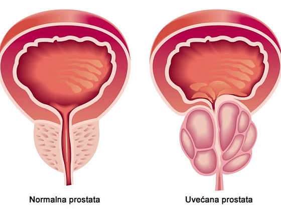 Prirodni lekovi za prostatu